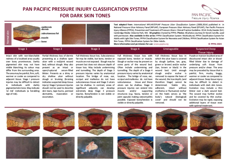 Illustration of resource describing the Pan Pacific Pressure Injury Classification System for Dark Skin Tones.