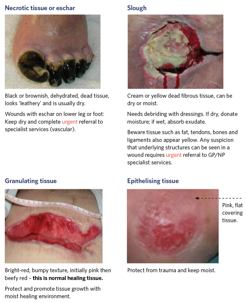 Illustrations to show tissue type for assessment of wound bed tissue and percentage of each tissue type. 